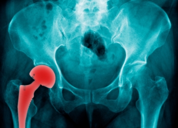 X-ray showing DePuy hip